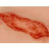 Wondmoulage arteriële beenulcus
