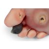 Wondvoet met diabetisch voetsyndroom - afbeelding 8